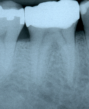 middle mesial canal